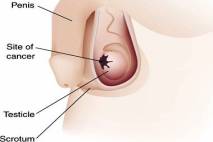 slika Tumori testisa (testicular cancer)